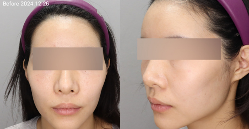 옆볼필러 - 광대를 필러로 축소한다? 전후사진