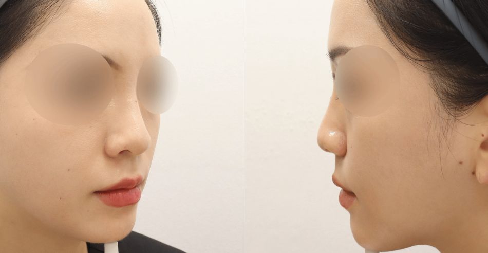 코필러? 미쥬코? 하이코? - 이 케이스에서의 선택은? 전후사진