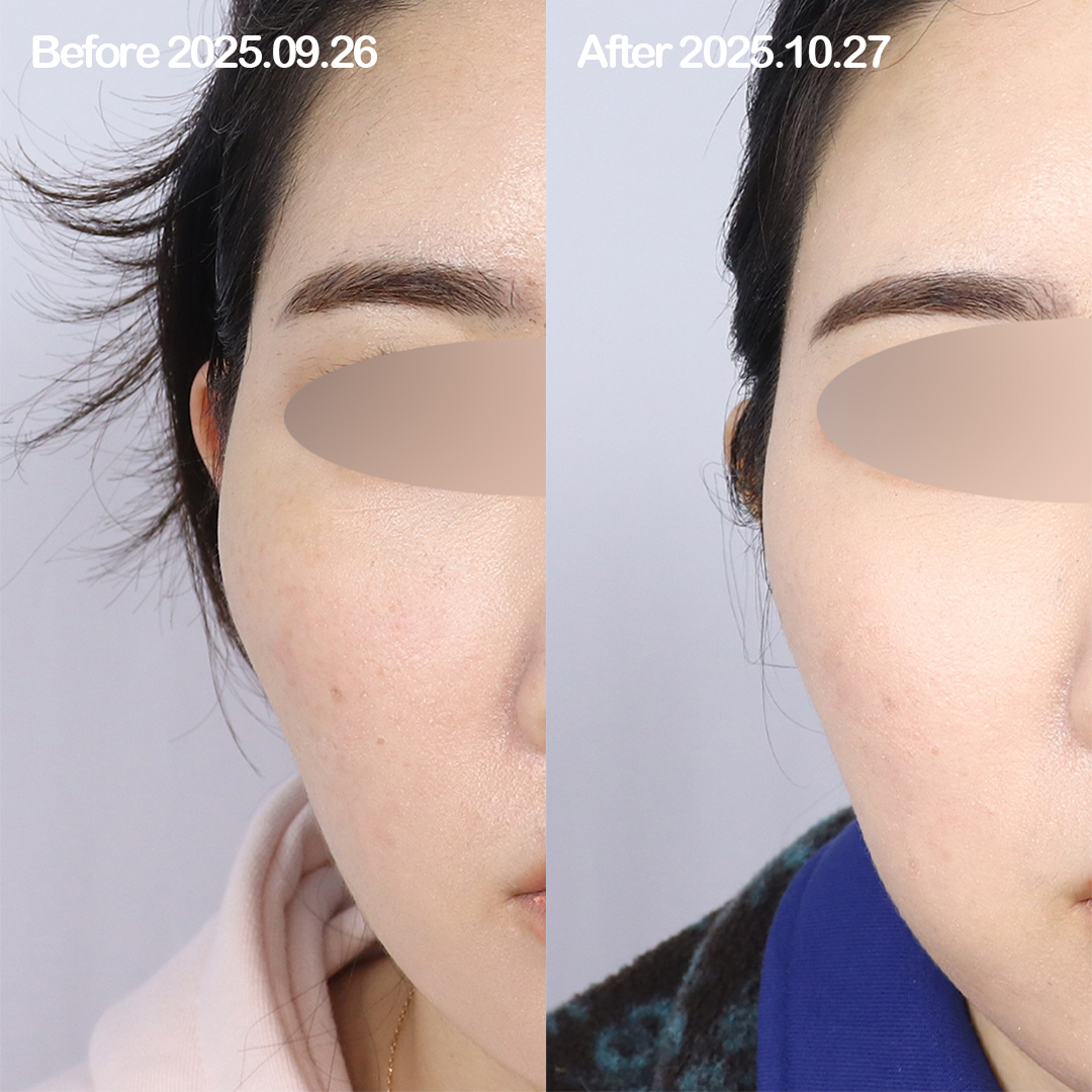 주사 또는 기기 복합 시술로 구현하는 옆광대 축소 효과: 해부학적 관점에서 본 실질적 변화 전후사진