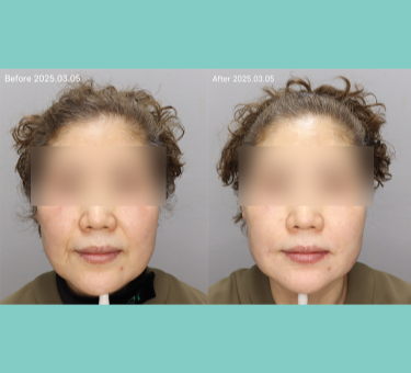 칼슘 부스터 레디어스 시술 이미지