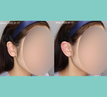 Before/After 특수부위 필러 시술 이미지