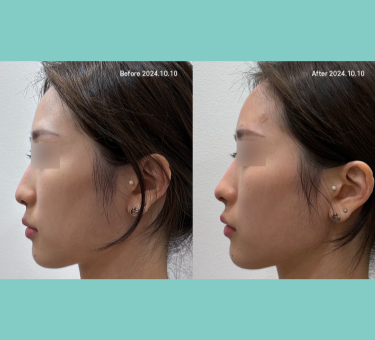 Before/After 이마필러 썸네일