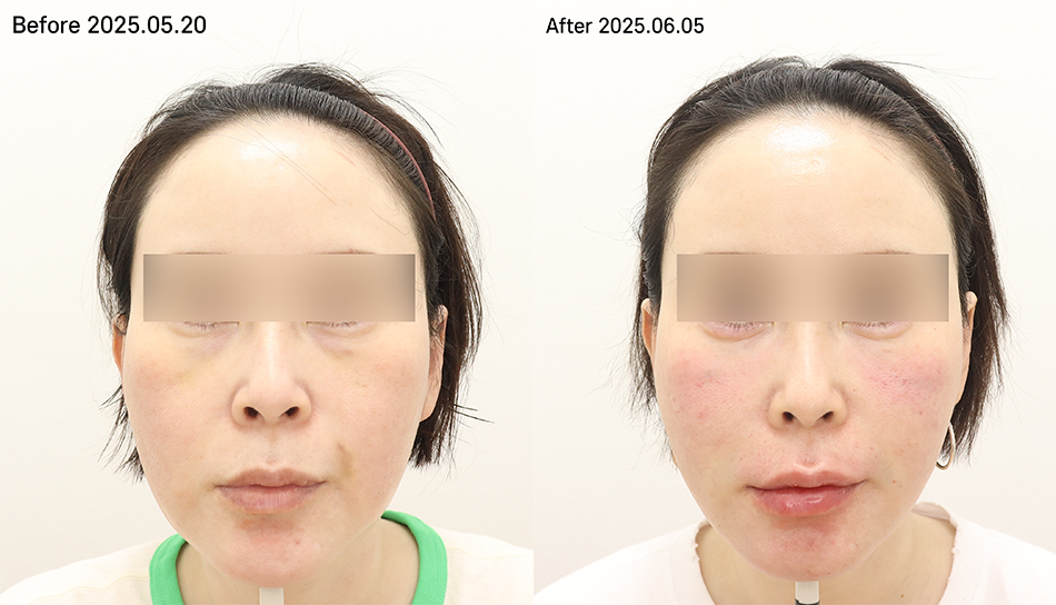 대전 풀페이스필러+레디어스 전후 이미지 1