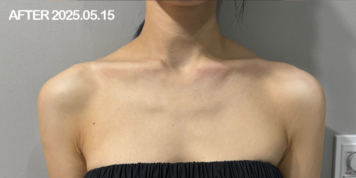 대전 직각 어깨 + 쇄골 필러 전후 이미지 1