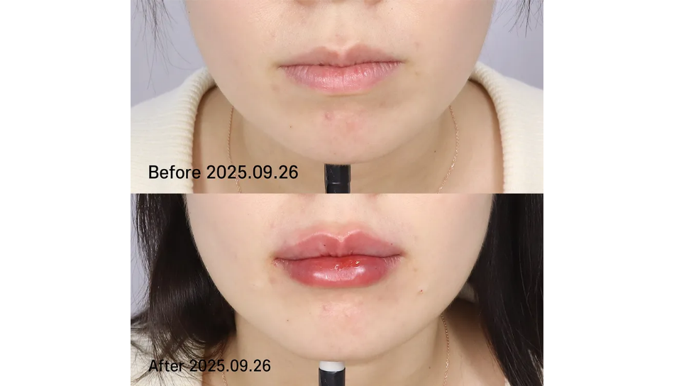 대전 입술필러 전후 이미지 1