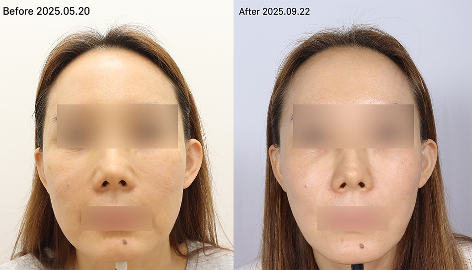 대전 스컬트라 2회차 전후 이미지 1