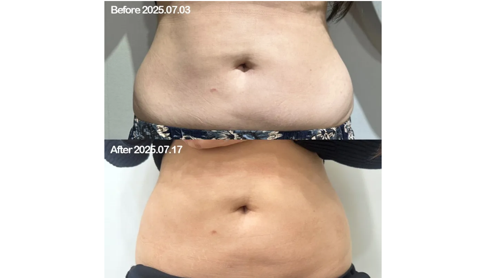 대전 러브핸들 지방추출주사 전후 이미지 1