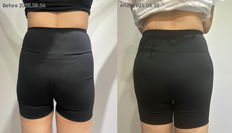 대전 골반필러 전후 이미지 1