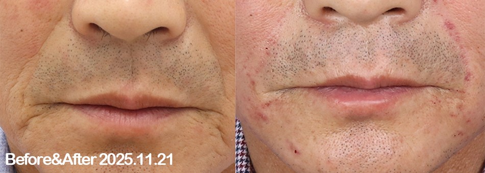 즉각효과 주름필러 Before