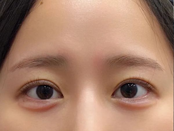 애교필러 정면 After