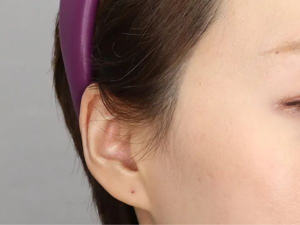 대전 엘프귀 필러 전후 이미지 1