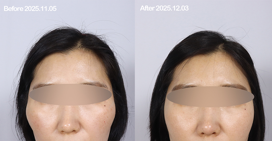 광대 축소 주사 Before