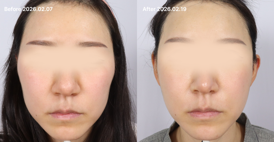 대전 풀페이스 디자인 필러 전후 이미지 1