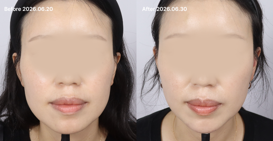 대전 관자,옆볼,턱선 필러 전후 이미지 1