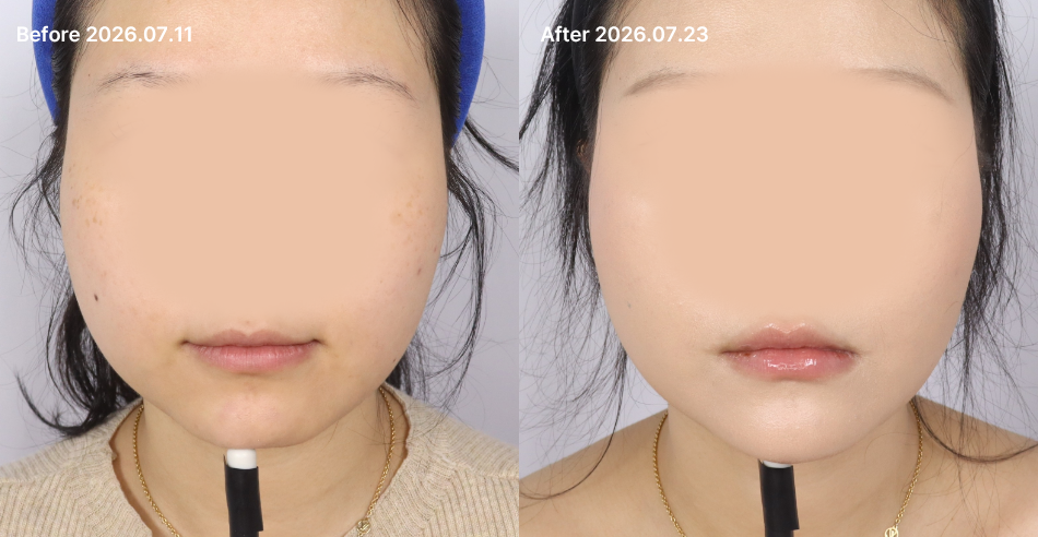 대전 턱끝 필러 전후 이미지 1